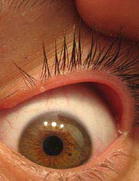 Blepharitis Itchy Eyes Doctor Eyelids