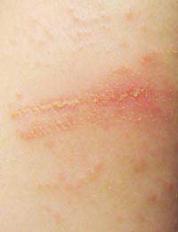 Contact Dermatitis Skin Diagnosis Red