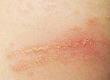 Identifying and Treating Contact Dermatitis