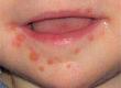 What is Hand, Foot and Mouth Disease