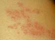 My Eight-year-old Had Shingles: Case Study