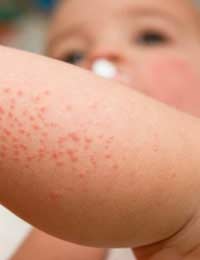 Eczema Baby Eczema Dryness Irritation