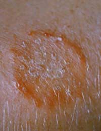 Ringworm Skin Worm Scalp Infection Wash