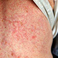 Rash Skin Rash Life-threatening Blisters