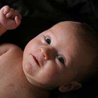 Baby Acne Cradle Cap Rash Eczema Infant