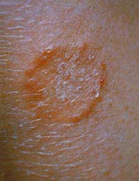 Fungal Skin Infection Skin Fungus Tinea