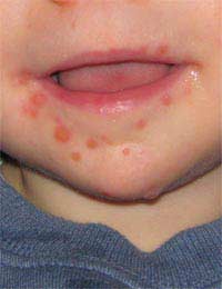 Hand Foot And Mouth Disease Illness