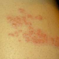 Shingles Rash Blisters Painful