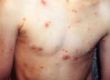Avoiding Chicken Pox Scars