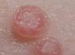 About Molluscum Contagiosum