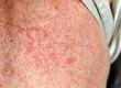 Life-Threatening Skin Rashes