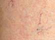 Thread and Varicose Veins