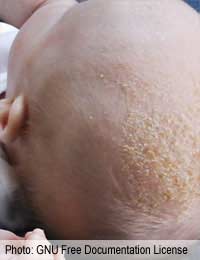 Cradle Cap Oils Seborrheic Dermatitis