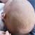 How to Combat Cradle Cap