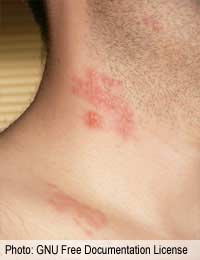 Shingles Chicken Pox Virus Rash