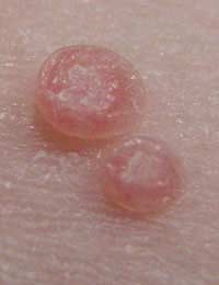 Molluscum Molluscum Contagiosum Wart