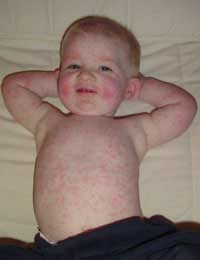 Fifth’s Disease Virus Immune System