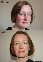 Skin Capers Rosacea Redness Cheeks Nose