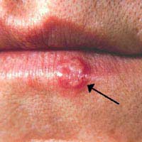 Genital Herpes Virus Herpes Simplex