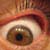 How I Cured My Blepharitis: A Case Study
