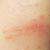 Identifying and Treating Contact Dermatitis