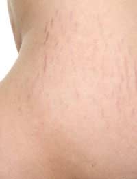 Stretch Marks Pregnancy Skin Puberty