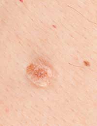 Seborrheic Keratoses Wart Gp Pregnancy