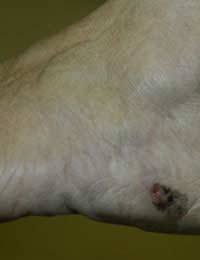 Skin Self-exam Cancer Mole Lesions