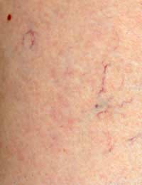 Thread Veins Varicose Veins Abnormal